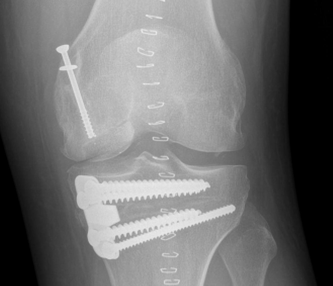 Osteochondral Allograft AP